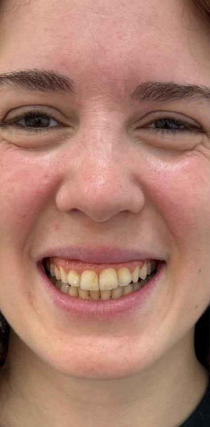 Antes del tratamiento dental con dientes en estado previo Antes del tratamiento dental con dientes en estado previo